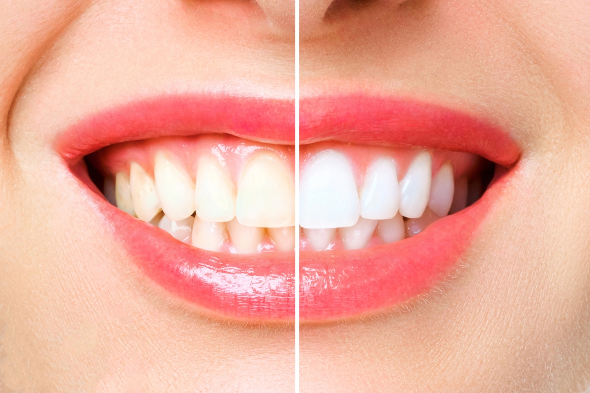 Professional-teeth-whitening-in-Holmdel