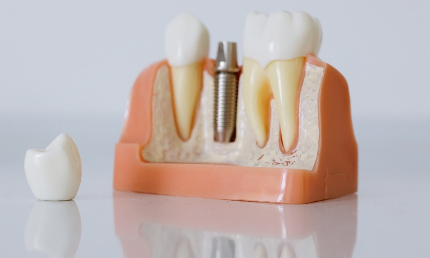 Can Smokers Get Dental Implants? Risks